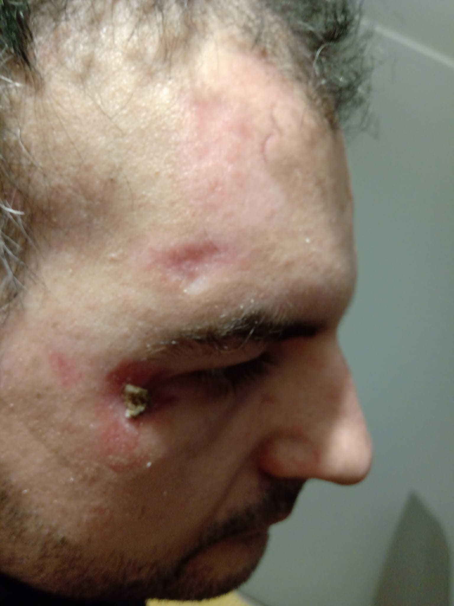 Po napadzie / post-seizure