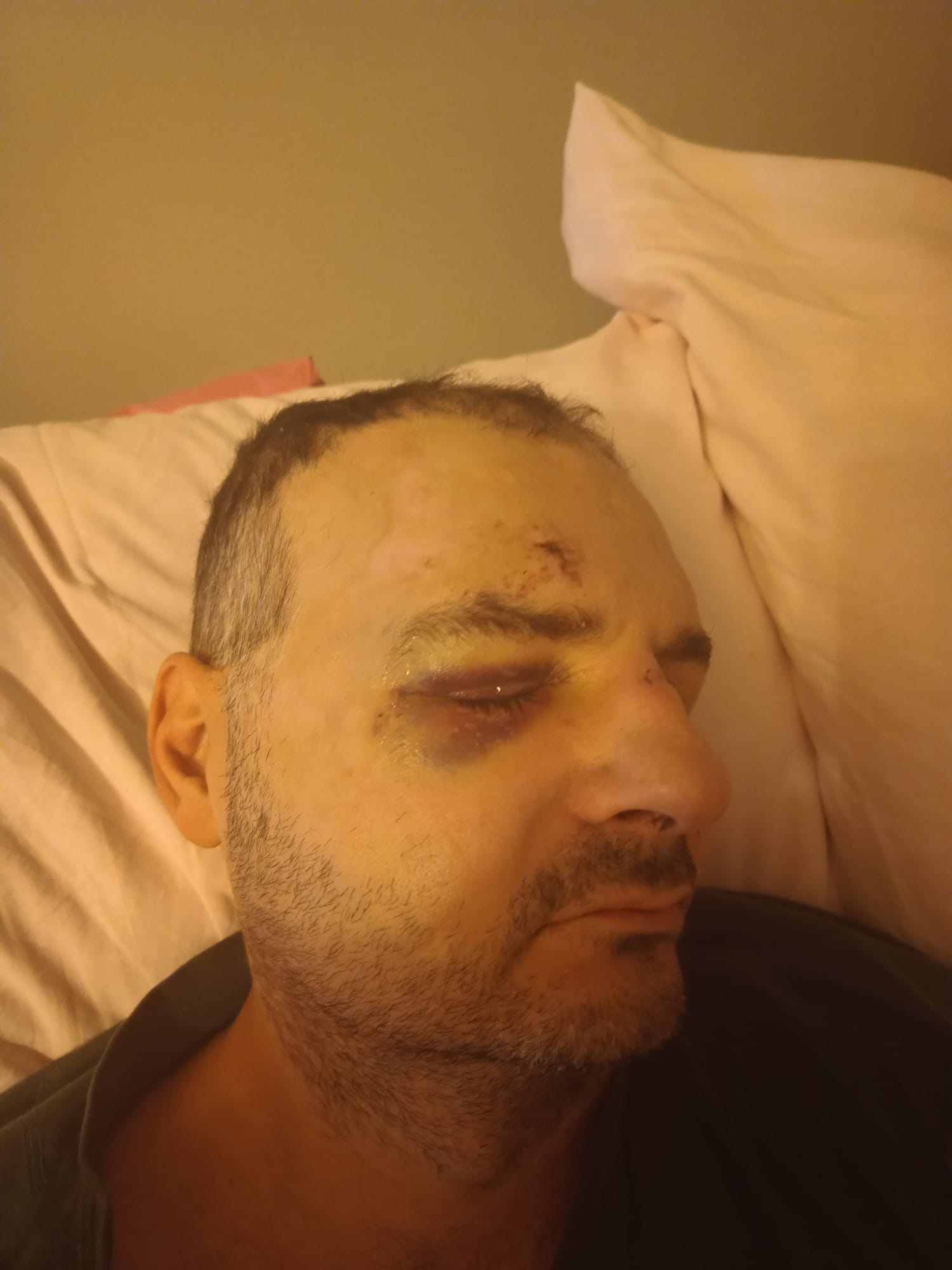 Po napadzie / post-seizure